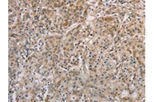 The image on the left is immunohistochemistry of paraffin-embedded Human gastic cancer tissue using ABIN7129403(ESRRG Antibody) at dilution 1/30, on the right is treated with fusion protein. (ESRRG antibody)