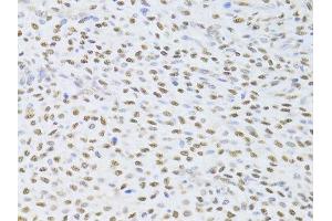 Immunohistochemistry of paraffin-embedded human adenomyosis using FKBP4 Antibody. (FKBP4 antibody  (AA 220-459))