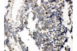 Anti- RUNX3 Picoband antibody, IHC(P) IHC(P): Human Lung Cancer Tissue