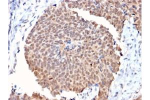 Formalin-fixed, paraffin-embedded human Breast Cancer stained with FAF1 Mouse Monoclonal Antibody (CPTC-FAF1-2). (FAF1 antibody)