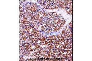 BAG2 Antibody (C-term) ((ABIN657974 and ABIN2846920))immunohistochemistry analysis in formalin fixed and paraffin embedded human ovarian carcinoma followed by peroxidase conjugation of the secondary antibody and DAB staining.