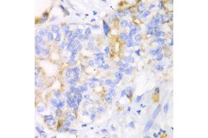 Immunohistochemistry of paraffin-embedded human liver cancer using CHIA antibody at dilution of 1:100 (x40 lens). (CHIA antibody)