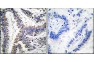Immunohistochemistry analysis of paraffin-embedded human lung carcinoma, using DFF45 (Cleaved-Asp224) Antibody. (DFFA antibody  (Cleaved-Asp224))