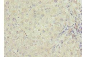 Immunohistochemistry of paraffin-embedded human liver cancer using ABIN7167252 at dilution of 1:100 (RAB23 antibody  (AA 1-237))