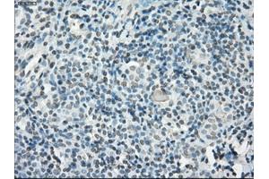 Immunohistochemical staining of paraffin-embedded Adenocarcinoma of ovary tissue using anti-PORmouse monoclonal antibody. (POR antibody)