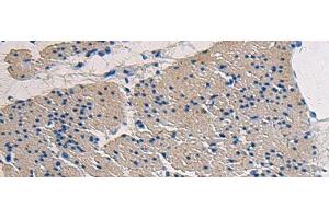 Immunohistochemistry of paraffin-embedded Human gastric cancer tissue using COL17A1 Polyclonal Antibody at dilution of 1:50(x200) (COL17A1 antibody)