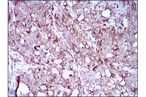 Immunohistochemical analysis of paraffin-embedded cervical cancer tissues using SYCP3 mouse mAb with DAB staining. (SYCP3 antibody  (AA 27-128))