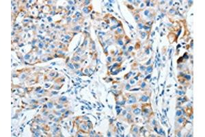 The image on the left is immunohistochemistry of paraffin-embedded Human breast cancer tissue using ABIN7128282(AGA Antibody) at dilution 1/20, on the right is treated with fusion protein. (AGA antibody)