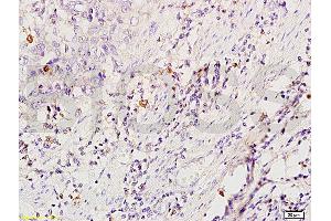 Formalin-fixed and paraffin embedded human esophageal carcinoma tissue labeled with Anti-CD86/B7-2 Polyclonal Antibody (ABIN736701), Unconjugated at 1:200 followed by conjugation to the secondary antibody and DAB staining