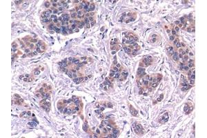 DAB staining on IHC-P; Samples: Human Liver cancer Tissue (Complement C4 antibody  (AA 975-1336))