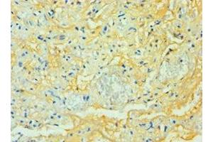 Immunohistochemistry of paraffin-embedded human lung tissue using ABIN7171585 at dilution of 1:100 (TTBK2 antibody  (AA 1185-1244))
