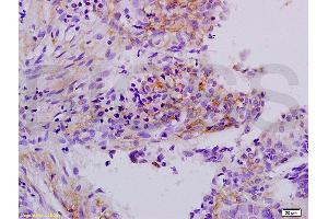 Formalin-fixed and paraffin embedded human laryngeal cancer labeled with Anti-APOH Polyclonal Antibody, Unconjugated (ABIN731483) at 1:200 followed by conjugation to the secondary antibody and DAB staining. (APOH antibody  (AA 281-345))
