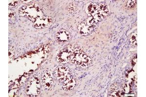 Formalin-fixed and paraffin embedded human breast carcinoma labeled with Anti-WNT4 Polyclonal Antibody, Unconjugated (ABIN762911) at 1:200 followed by conjugation to the secondary antibody and DAB staining (WNT4 antibody  (AA 201-300))