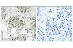 Immunohistochemistry analysis of paraffin-embedded human breast carcinoma tissue, using USP13 antibody. (USP13 antibody)