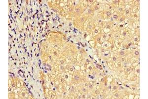Immunohistochemistry of paraffin-embedded human liver cancer using ABIN7151414 at dilution of 1:100 (EFCAB7 antibody  (AA 1-158))