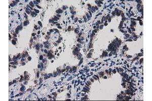 Immunohistochemical staining of paraffin-embedded Carcinoma of Human thyroid tissue using anti-HDHD1A mouse monoclonal antibody.