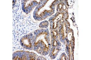 Anti-Hydroxysteroid(17-beta) Dehydrogenase 4 antibody, IHC(P) IHC(P): Human Intestinal Cancer Tissue (HSD17B4 antibody  (C-Term))