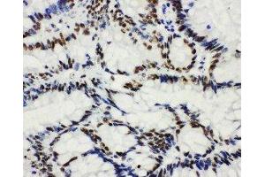 Anti-HDAC3 antibody,  IHC(P) IHC(P): Human Intestinal Cancer Tissue (HDAC3 antibody  (C-Term))