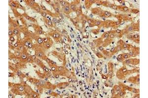 Immunohistochemistry of paraffin-embedded human liver cancer using ABIN7149738 at dilution of 1:100 (DEPDC1B antibody  (AA 343-529))