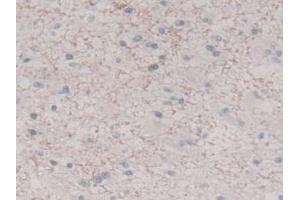 IHC-P analysis of Human Glioma Tissue, with DAB staining. (IL-8 antibody  (AA 23-101))