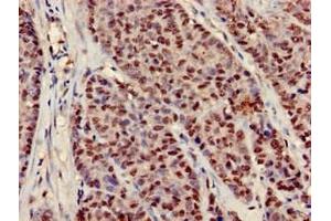 Immunohistochemistry of paraffin-embedded human ovarian cancer using ABIN7151782 at dilution of 1:100 (NEDD9 antibody  (AA 68-151))