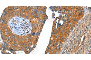 Immunohistochemistry of paraffin-embedded Human cervical cancer using ACOT11 Polyclonal Antibody at dilution of 1:40 (ACOT11 antibody)