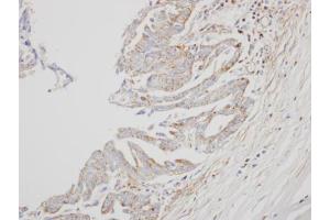 IHC-P Image Immunohistochemical analysis of paraffin-embedded OVCA xenograft, using interferon alpha 8, antibody at 1:500 dilution.