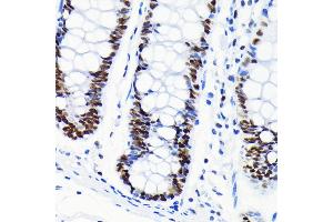 Immunohistochemistry of paraffin-embedded human colon using Chk2 antibody (ABIN7266294) at dilution of 1:100 (40x lens). (CHEK2 antibody)