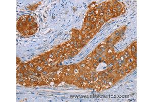 Immunohistochemistry of Human cervical cancer using MMP1 Polyclonal Antibody at dilution of 1:55 (MMP1 antibody)
