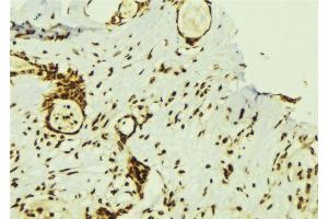 ABIN6274357 at 1/100 staining Human breast cancer tissue by IHC-P. (ZNF638 antibody  (Internal Region))