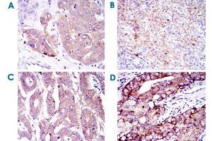 Immunohistochemical analysis of paraffin-embedded human liver cancer (A) , submaxillary tumor (B) , stomach cancer (C) and prostate cancer (D) using EIF4E monoclonal antibody, clone 5D11  with DAB staining. (EIF4E antibody)
