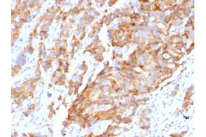 Formalin-fixed, paraffin-embedded human Prostate Carcinoma stained with Aurora B Mouse Monoclonal Antibody (AURKB/1592). (Aurora Kinase B antibody  (AA 89-251))