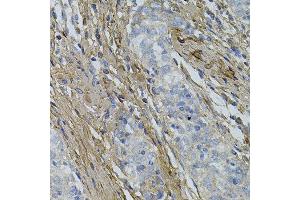 Immunohistochemistry of paraffin-embedded human esophageal cancer using COL1A1 antibody. (COL1A1 antibody)