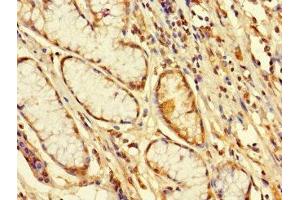 Immunohistochemistry of paraffin-embedded human gastric cancer using ABIN7152491 at dilution of 1:100 (FBXW12 antibody  (AA 1-250))