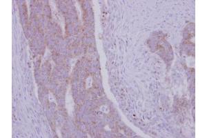 IHC-P Image Immunohistochemical analysis of paraffin-embedded human colon carcinoma, using RRM1, antibody at 1:500 dilution. (RRM1 antibody  (Center))