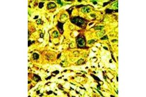 Formalin-fixed and paraffin-embedded human cancer tissue reacted with the primary antibody, which was peroxidase-conjugated to the secondary antibody, followed by AEC staining. (PKC delta antibody  (N-Term))