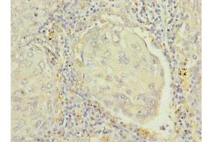 Immunohistochemistry of paraffin-embedded human lung cancer using ABIN7167399 at dilution of 1:100 (RAP1B antibody  (AA 1-181))