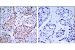 Immunohistochemistry analysis of paraffin-embedded human breast carcinoma, using HER2 (Phospho-Tyr1221/Tyr1222) Antibody. (ErbB2/Her2 antibody  (pTyr1221))