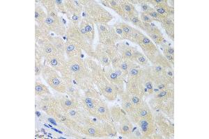 Immunohistochemistry of paraffin-embedded human liver cancer using PON1 antibody at dilution of 1:100 (40x lens).