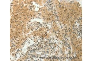 Immunohistochemistry of Human lung cancer using SLC8A3 Polyclonal Antibody at dilution of 1:70 (SLC8A3 antibody)