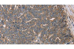 Immunohistochemistry of paraffin-embedded Human cervical cancer using HSD17B12 Polyclonal Antibody at dilution of 1:30 (HSD17B12 antibody)