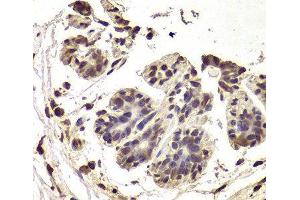 Immunohistochemistry of paraffin-embedded Human breast cancer using INTS6 Polyclonal Antibody at dilution of 1:100 (40x lens). (INTS6 antibody)
