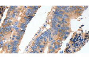 Immunohistochemistry of paraffin-embedded Human colon cancer tissue using MUC6 Polyclonal Antibody at dilution 1:40 (MUC6 antibody)