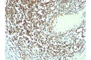 Formalin-fixed, paraffin-embedded human Bladder carcinoma stained with Nucleolin MAb (364-5 + NCL/902). (Nucleolin antibody)