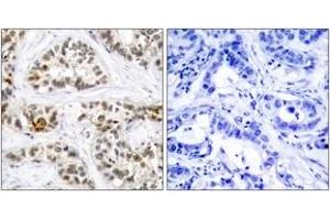 Immunohistochemistry analysis of paraffin-embedded human breast carcinoma, using RelB (Phospho-Ser552) Antibody. (RELB antibody  (pSer573))