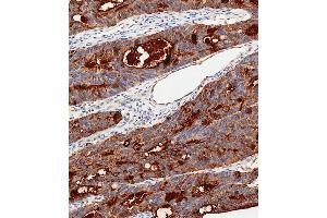 Immunohistochemical analysis of paraffin-embedded Human colon carcinoma tissue using C performed on the Leica® BOND RXm. (CEA antibody  (AA 400-429))