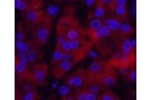 Immunofluorescence analysis of Human stomach cancer tissue using Ubiquitin Monoclonal Antibody at dilution of 1:200. (Ubiquitin antibody)