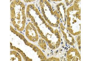 Immunohistochemistry of paraffin-embedded Human kidney cancer using UGT1A4 Polyclonal Antibody at dilution of 1:200 (40x lens). (UGT1A4 antibody)