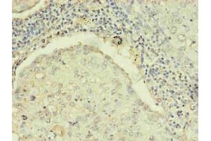 Immunohistochemistry of paraffin-embedded human lung cancer using ABIN7168449 in 30 μg/mL dilute concentrations. (RRM1 antibody)