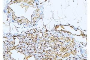 ABIN6275232 at 1/100 staining Human lung cancer tissue by IHC-P. (MRPS2 antibody  (C-Term))